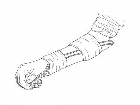 File:Splinting-an-arm.png - Wikimedia Commons